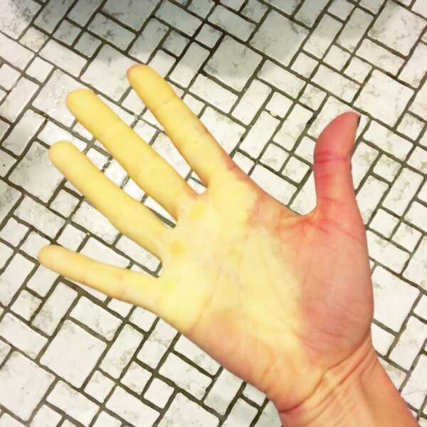 raynauds-syndrome-hand