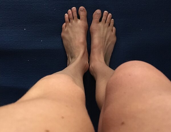 swollen-knee